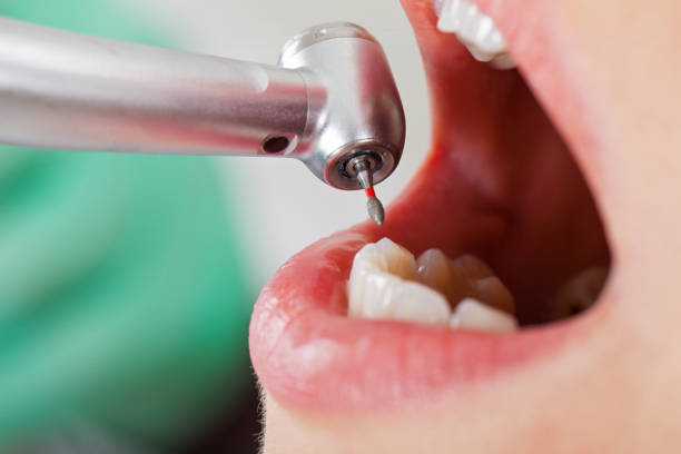 Best Emergency Wisdom Tooth Extraction in Penitas, TX